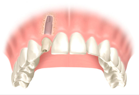 Implantologia, Studio Dentistico Vecchiatini